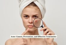 Acne: Causes, Prevention, and Effective Treatments