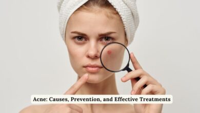 Acne: Causes, Prevention, and Effective Treatments