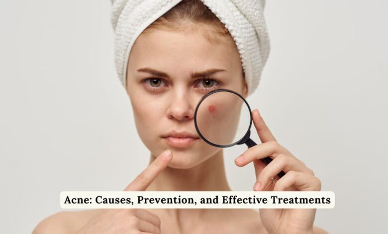 Acne: Causes, Prevention, and Effective Treatments